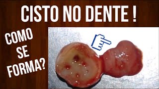 Como um CISTO NO DENTE se forma [upl. by Melonie462]