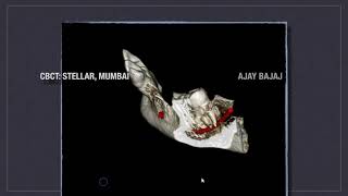 HOW TO MANAGE CURVED CANAL CASES [upl. by Anwahsit]