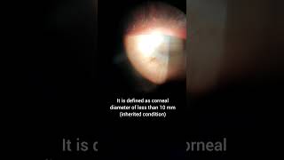 Microcornea smallcornea genetic eye disease cornea micro small [upl. by Mollie]