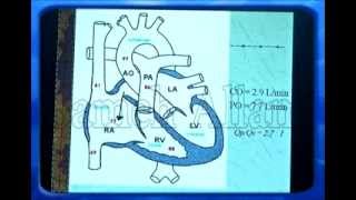 congenital heart disease ASD 1 [upl. by Eolanda]