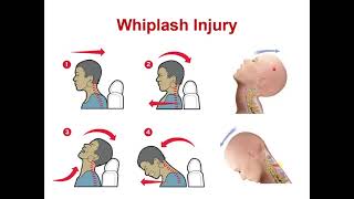 lecture 3 completion atlantoaxial  atlantooccipital joints   Hyoid bone [upl. by Kenweigh]