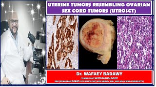 UTERINE TUMORS RESEMBLING OVARIAN SEX CORD TUMORS By Dr WAFAEY BADAWY [upl. by Brunell]