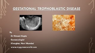 Gestational Trophoblastic Disease  Video SeriesEpi1 [upl. by Belden]