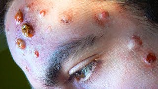 Worst Cystic Acne Thick Whiteheads amp Blackhead Removal 💯💯💯 [upl. by Buatti]