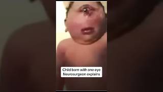 defect child born with conjoined eye neurosurgery neurosurgeon holoprosencephaly cyclopia [upl. by Atworth]