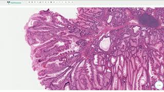 PeutzJeghers Polyp  Histopathology [upl. by Vrablik374]