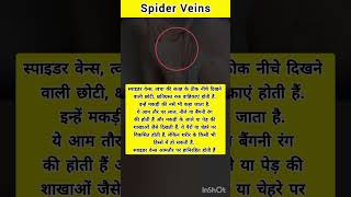 Whats the Spider Veins  healthfacts medicalfacts medicalcondition spiderveins health disease [upl. by Siva265]