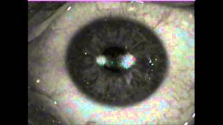 My left eye Topoguided PRKCXL laser surgery on 20140828 [upl. by Libre]