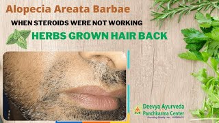 Herbs for Alopecia Areata Barabe [upl. by Sigfrid330]