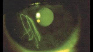 corneal abrasions [upl. by Arykat]