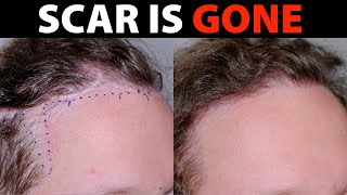 How to Get Rid of a Scar with a Hair Transplant [upl. by Aura]