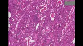 Histopathology KidneyChronic glomerulonephritis [upl. by Luaped]