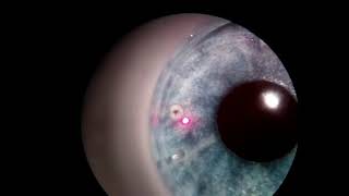 Laser Peripheral Iridotomy with a Model Eye [upl. by Obala]