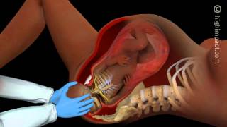 Brachial Plexus Injury [upl. by Newra866]