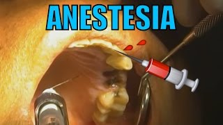 ANESTESIA DENTAL HD [upl. by Chicoine]