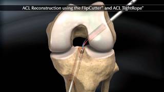 ACL Reconstruction using the FlipCutter and ACL TightRope [upl. by Butterfield815]