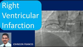 Right Ventricular Infarction [upl. by Xineohp]