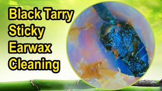 We Tested 3 Methods for Black Tarry Earwax Removal Heres What Works [upl. by Simonne840]