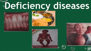 Deficiency diseases components of Food  deficiency diseases class 6 [upl. by Eldwun]