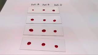 Blood typingRh positive slide agglutination test MEDICAL LABORATORY SCIENCE [upl. by Milo255]