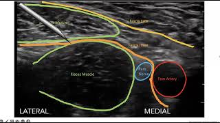 Ultrasound Guided Fascia Iliaca Block [upl. by Kistner792]