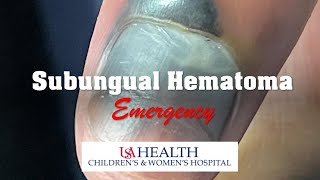 Subungual Hematoma Emergency and Trephination Procedure [upl. by Suqram]