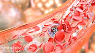 Metastasis and angiogenesis [upl. by Dranal]