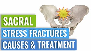 Sacral Stress Fractures  Causes amp Treatment [upl. by Gladdie]