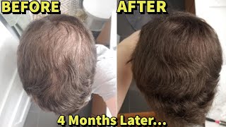 He Was Microneedling WITHOUT FinasterideMinoxidil For 4 MonthsSHOCKING Results [upl. by Leira929]