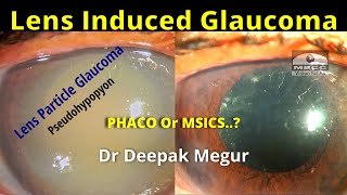 PseudoHypopyon Hypermature Cataract with Lens Induced Glaucoma  Phaco Or SICS Dr Deepak Megur [upl. by Goodden382]