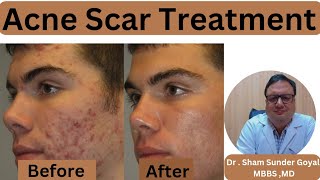 Acne Scar Treatment Results  Acne Scars  Kayakalp Laser Clinic [upl. by Atikir14]