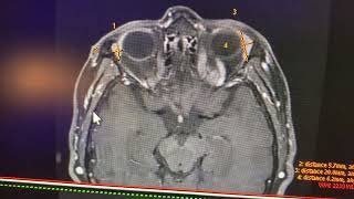 Miositis orbitaría pseudo tumor inflamatorio de la órbita [upl. by Ahmed]