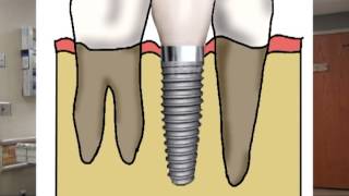 All ceramic crown quottooth preparationquot  for dental students [upl. by Ainafets]