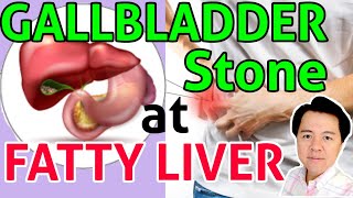 GallBladder Stone at Fatty Liver Paano Gamutin  Payo ni Doc Willie Ong 130b [upl. by Yenobe]