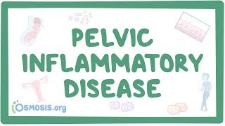 Pelvic inflammatory disease  causes symptoms diagnosis treatment pathology [upl. by Zuzana]