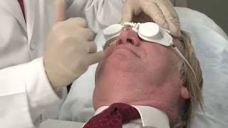 Laser Clearance of Facial Veins and Redness for Males [upl. by Asiaj]