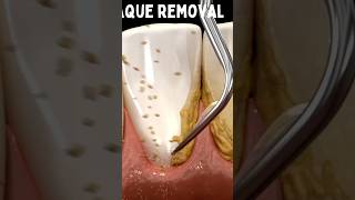 Dental plaque removal by water pick biology teethcleaning tartar dentaltartar biofilm [upl. by Pryce]