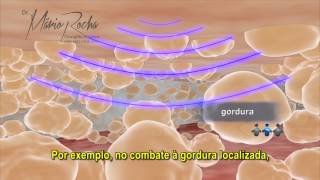 Ultrassom para tratamento de Celulite Gordura Localizada e Flacidez [upl. by Aitnyc]