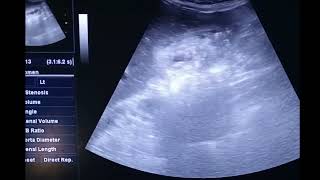 Gallbladder adenomyomatosis on Ultrasound diffuse type [upl. by Hally]