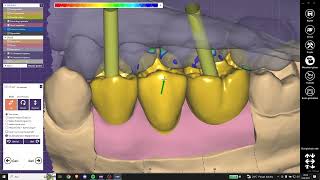 Exocad İmplant Altyapı Tasarımı  Substructure Implant Design in Exocad [upl. by Encrata]