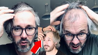 BALDING Man Has A LIFE CHANGING TRANSFORMATION [upl. by Castorina]