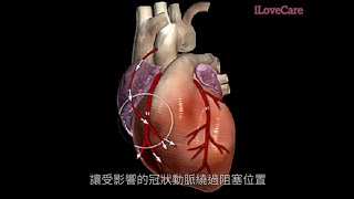 【1分鐘✅理解💖心臟搭橋手術🏥】《👍 Understand 💖 Coronary Artery Bypass Grafting CABG 💕 in 1 min 😘》 [upl. by Fowle]