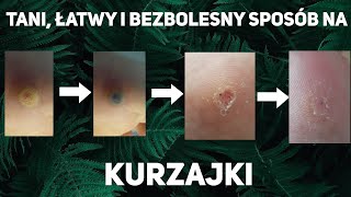 Kurzajki – Jak naturalnie się ich pozbyć [upl. by Aloek]