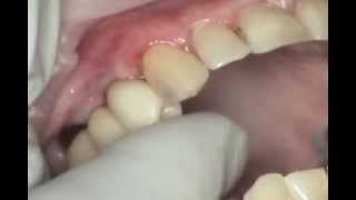 Mise en place dun bridge composite CFAO 3 éléments sur implants Bicon [upl. by Winshell]