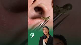 Blackhead in ear blackhead acne blackheads blackheadremoval [upl. by Naga]