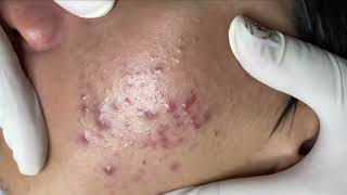 Blackheads amp Whiteheads Removal New 2024 Acne Treatment With Nhat Bang [upl. by Grindlay704]