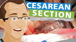 Cesarean Section [upl. by Ennirroc]