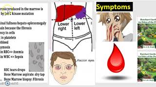 Primary Myelofibrosis PMF Bone Marrow Fibrosis Neoplasm Cause Symptoms Treatment USMLE MCAT 3 mn [upl. by Streetman]