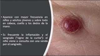 Dermatoscopia de los tumores vasculares [upl. by Okia]