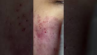 Big Cystic Acne Blackheads Extraction Blackheads amp Milia Whiteheads Removal Pimple Popping [upl. by Airtap]